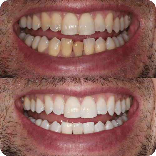 Tooth Beutification Cosmetic Dentistry Brooklyn: Enhance Your Smile